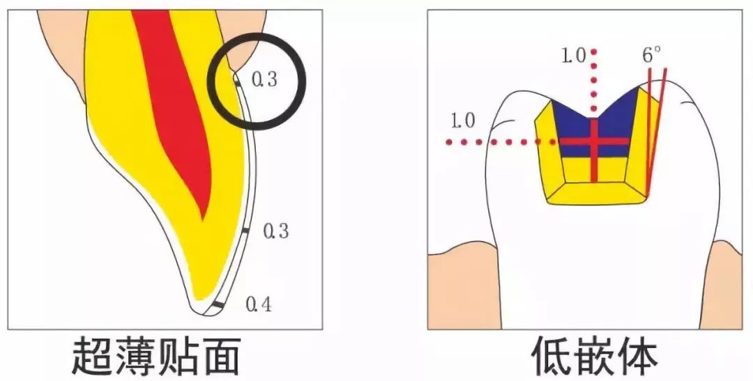 【牙医必备】牙体预备及全瓷牙备牙要求!