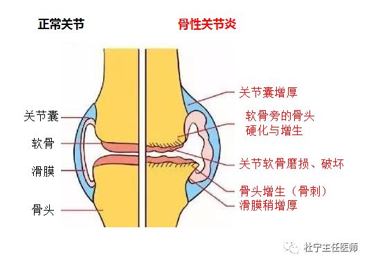 膝關節骨關節炎哪些症狀