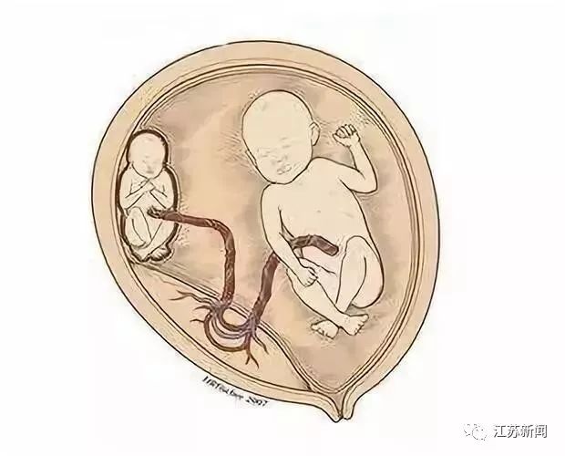 营养都吸走双胞胎在妈妈肚子里抢血差点出大事