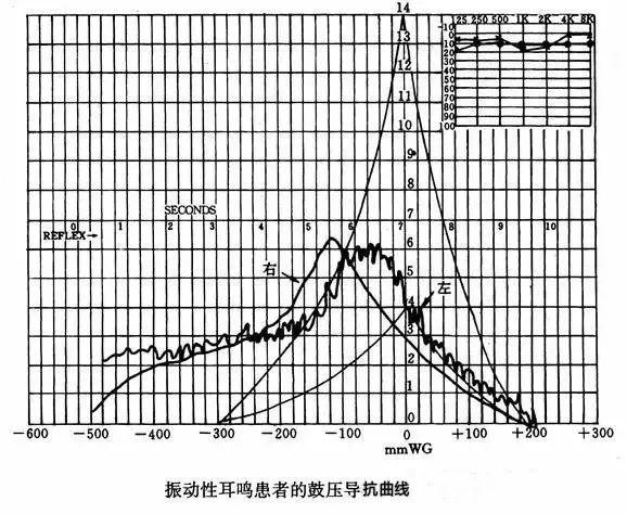 鼓室导抗图as型图片