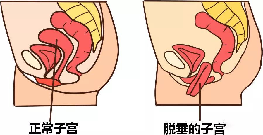 盆腔器官,特别是子宫,喜欢"钻空子".