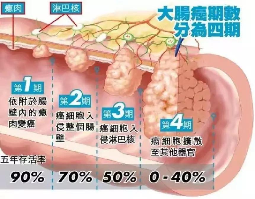 张立杰|检查发现肠息肉千万不要”视而不见“！