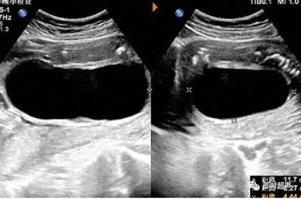 梅干腹综合征(pbs)_超声