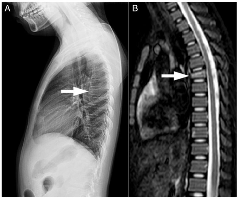 圖1 x線與mr檢查提示第六胸椎壓縮性骨折據李教授介紹,儘管患兒診斷
