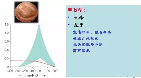 3,b型鼓室图曲线2,c型鼓室图曲线1,a型鼓室图曲线临床上常用的声导抗