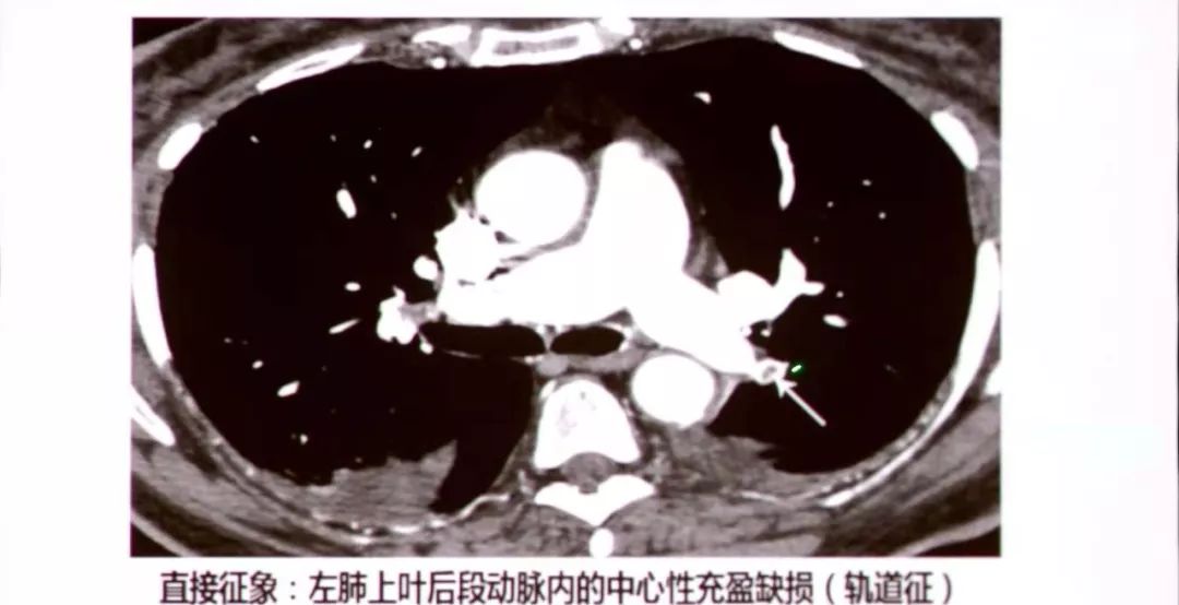 附壁充盈缺损;3.完全闭塞;4."轨道征"即心充盈缺损;5.