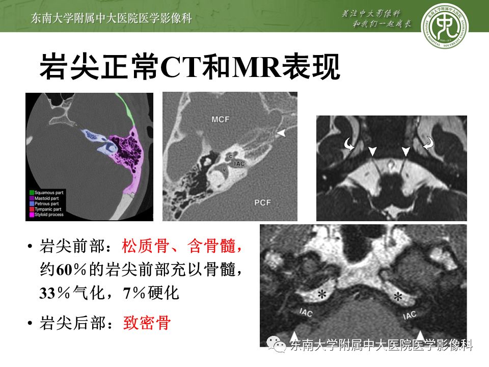 病例结果:颞骨岩尖部病变编辑/校对:郑孝飞平扫mr女,66岁,因"头晕2月
