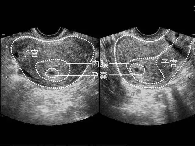 假孕囊不会随孕周的增大而增大,甚至会缩小或消失,这种情况宫外孕的