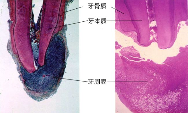 图16为患有根尖病变的牙齿的病理组织标本