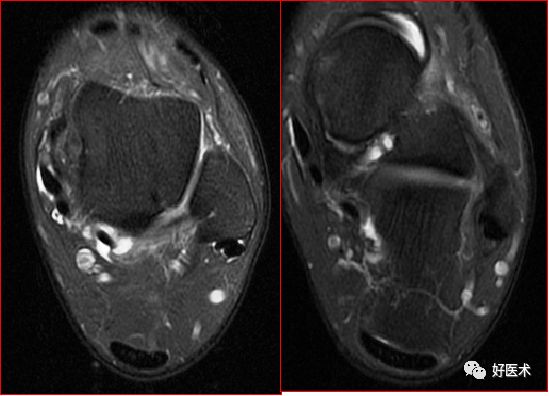 跟腱mri图片图片