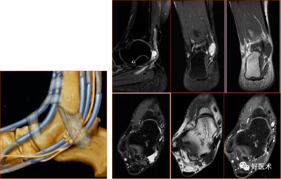距骨骨缺血坏死,胫骨骨梗死