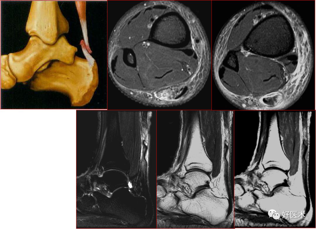跟腱断裂mri图片