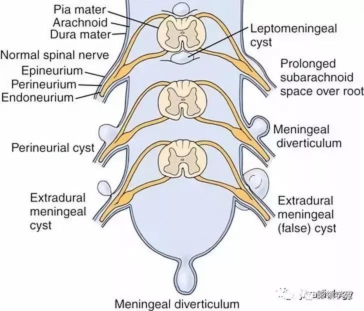 椎管内囊性病变的分类和影像诊断