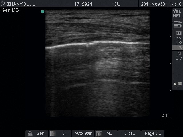 跬步千里frommon重症超声规范化诊治流程8气胸诊治流程