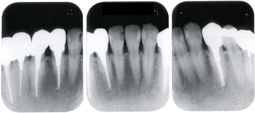 根管治疗策略是取决于其是否感染