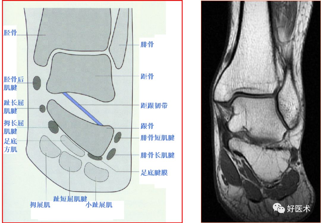 踝关节mri解剖与常见病变,都在这篇文章里!