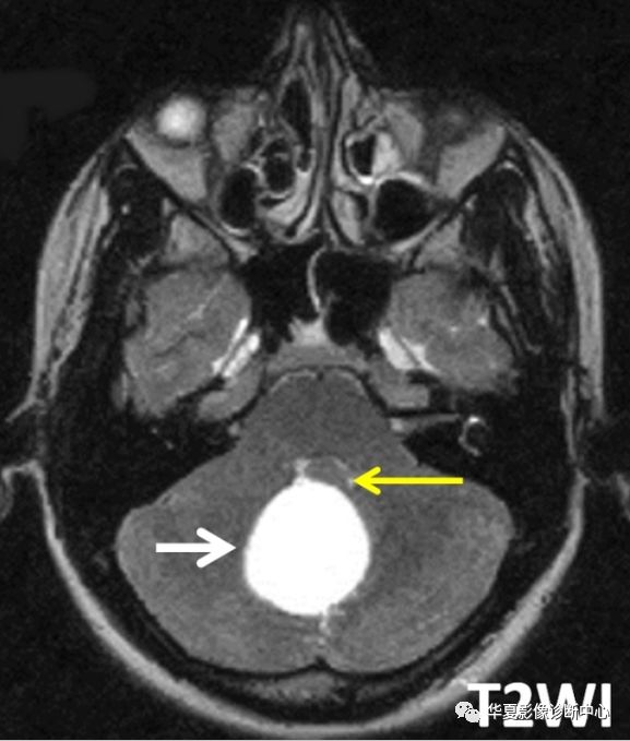 影像拾遗颅内这个囊肿你见过吗带你认识blakes囊肿