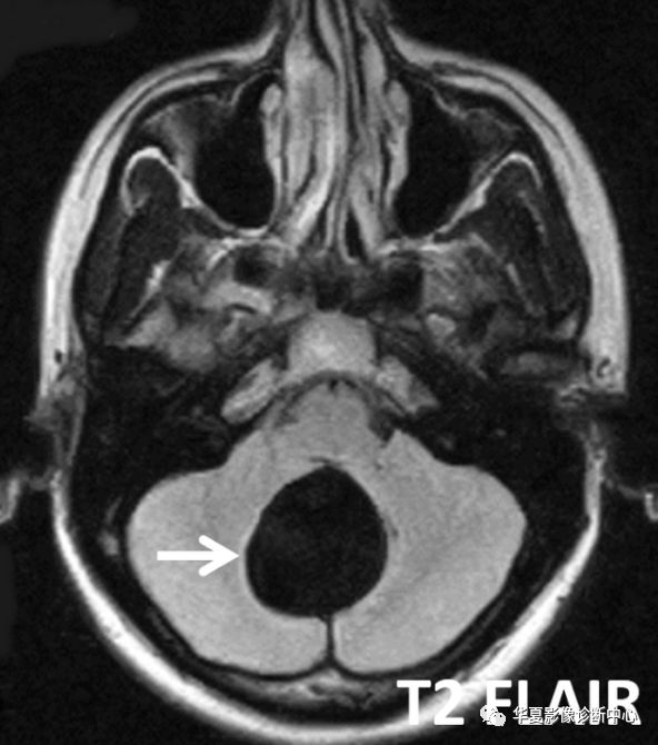脑内囊肿图片