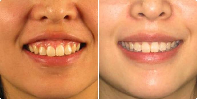 什么是骨性龅牙?和牙性龅牙有何不同?怎么才能矫正?