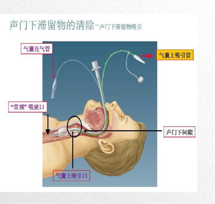 又称声门下滞留物,是指气囊上滞留物,主要是口腔分泌物,胃食管反流物