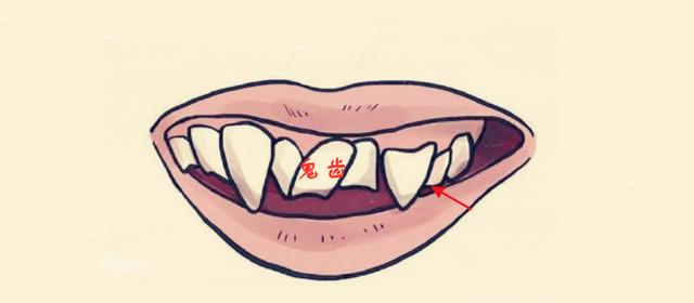 鬼齿所谓鬼齿指的是牙齿长的非常凌乱不齐,看上去东倒西歪,猛一看还