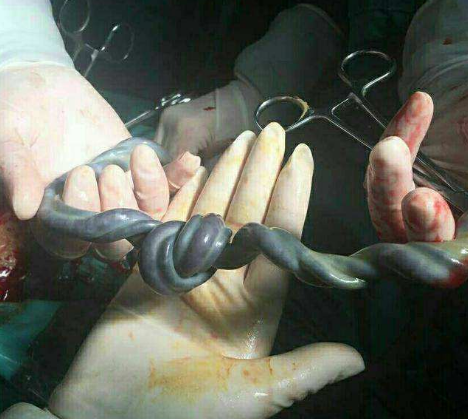 孕晚期胎儿脐带绕颈,打结,需要注意以下几点