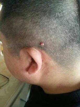 一般人在看到小肉瘤时,强迫症就犯了,特别想抠掉.