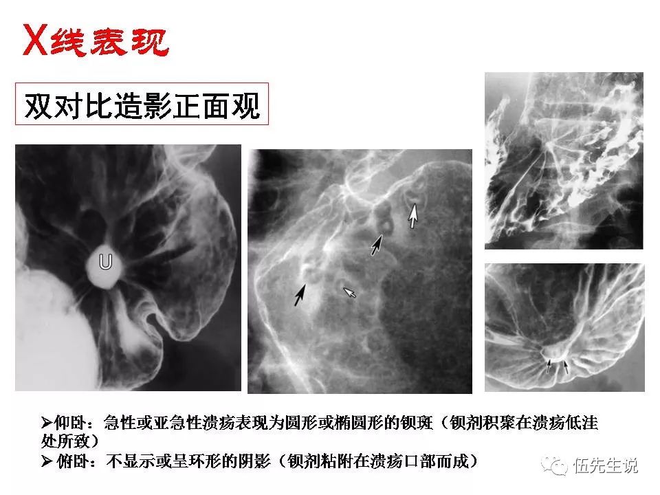 良性龛影与恶性龛影图片