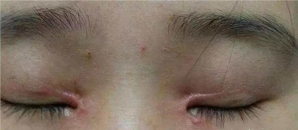 王春燕:双眼皮手术是否一定会留下疤痕?