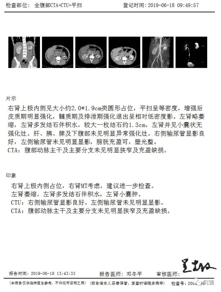 164号作品:右肾癌合并左肾多发结石一期治疗