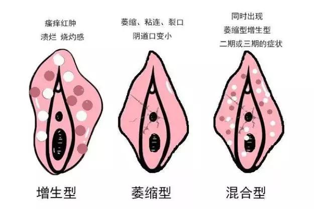 外阴白斑早期图片症状图片