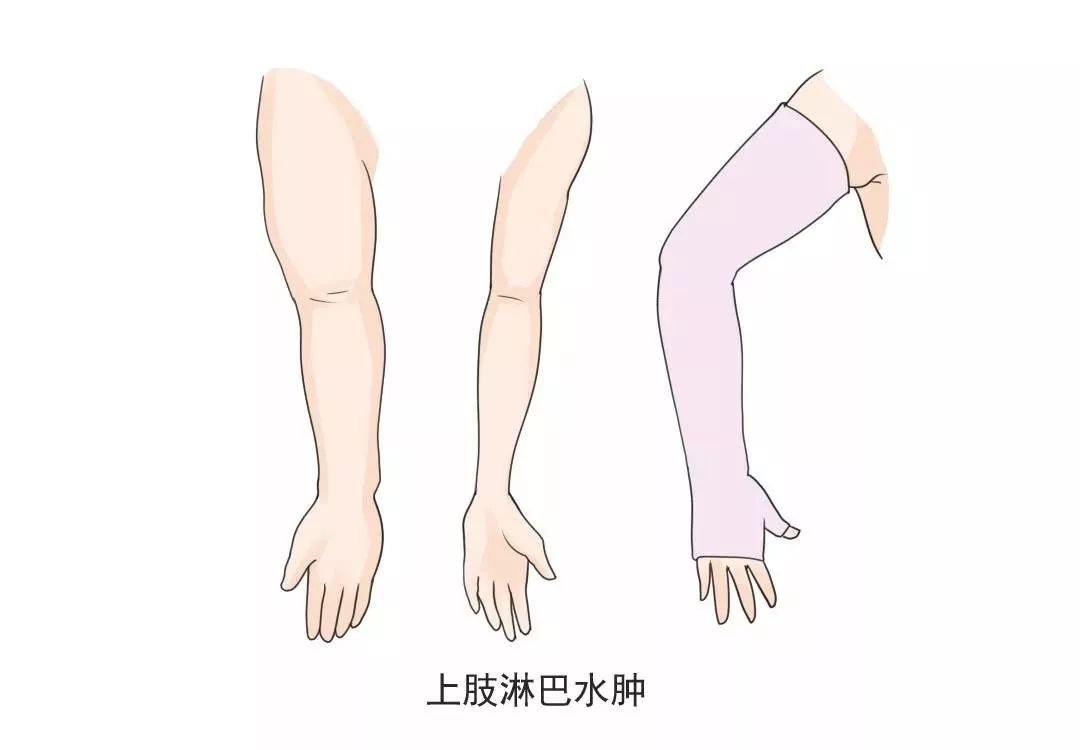 上肢活动与淋巴水肿上肢功能评估03骨密度检测,如果绝经后或服用第三