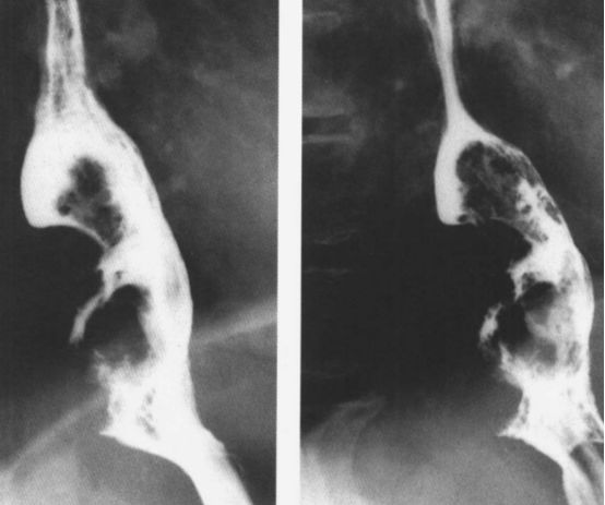 食管癌龛影图片图片