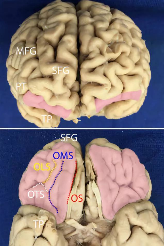 神外专题(二)| 大脑白质纤维束的解剖意义
