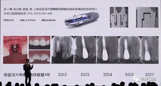 拓美种植体图片