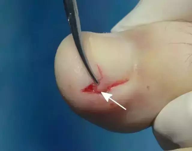 而且运动比较多的人,甲刺到肉里面的表现就越明显.