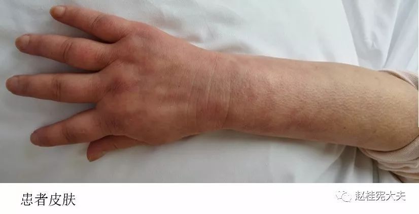 一般情况欠佳,面部及四肢皮肤肿胀,僵硬,橘皮样改变,皮肤无法提起