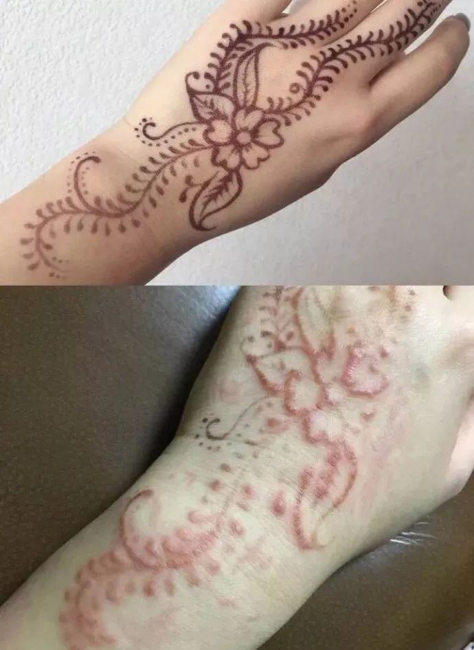 看似简单的海娜纹身背后存在着极大风险