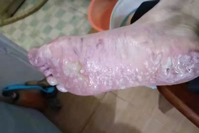 可怕龙文区这30多位村民因参加这种民俗活动脚底不同程度被烫伤