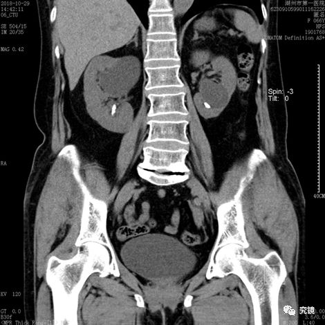 输尿管囊肿ct图片图片