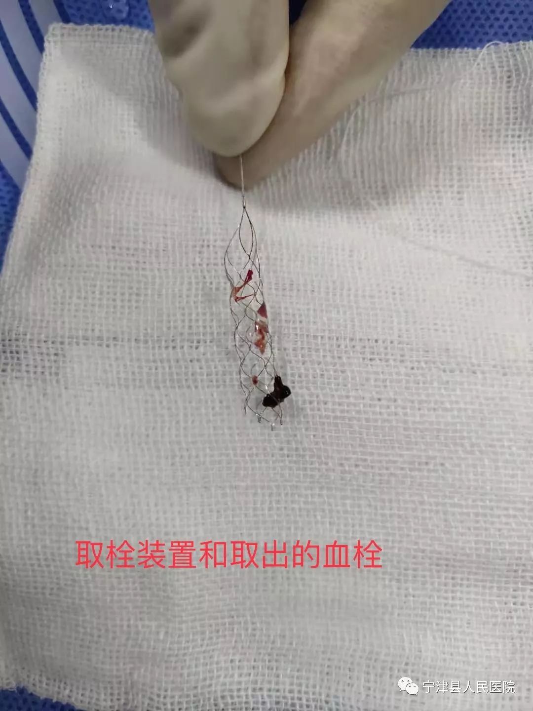 溶栓 取栓= 打通大脑生命线