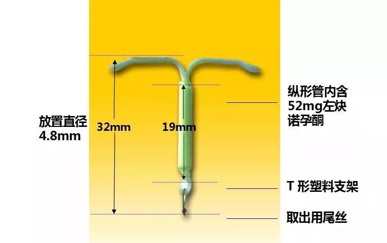 曼月乐环知多少牟医妇科专家来解答