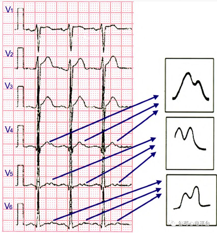 心电图t波改变 图解图片