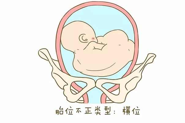 胎儿rot胎位图片图片