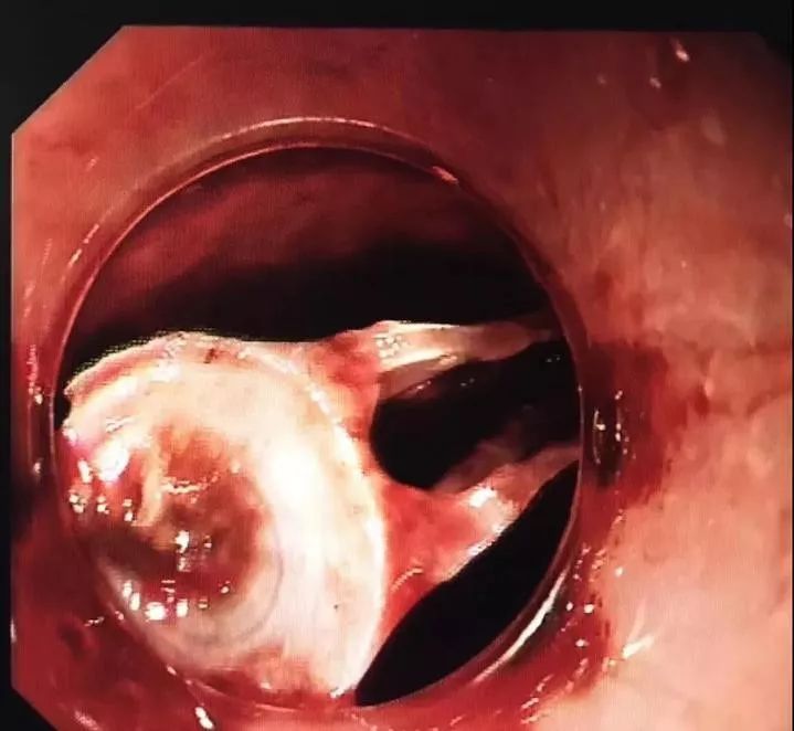 男子鱼刺卡喉咙医生竟让他赶紧吃手套