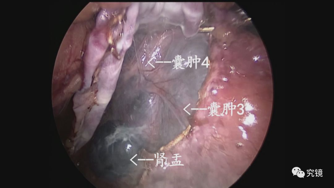 182号作品 美蓝辅助腹腔镜处理复杂肾盂旁囊肿