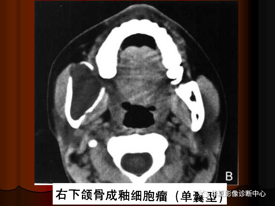 口腔颌面部ct诊断