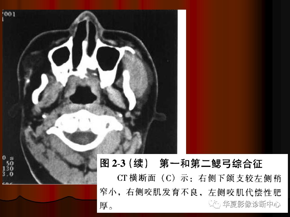 上下颌骨ct平扫解剖图片