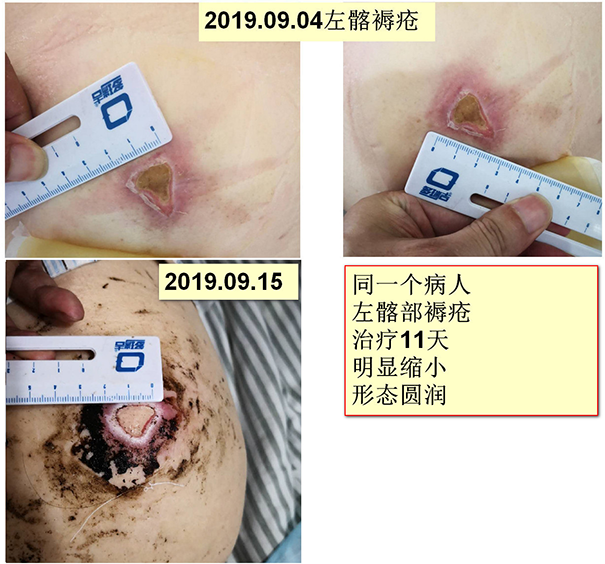 擅长：烧（创）伤后瘢痕挛缩及先天性体表畸形的整复、难治性创面（褥疮）的修复、体表肿瘤、...号贩子代挂-加微信咨询挂号!进京需持72小时内核算的简单介绍