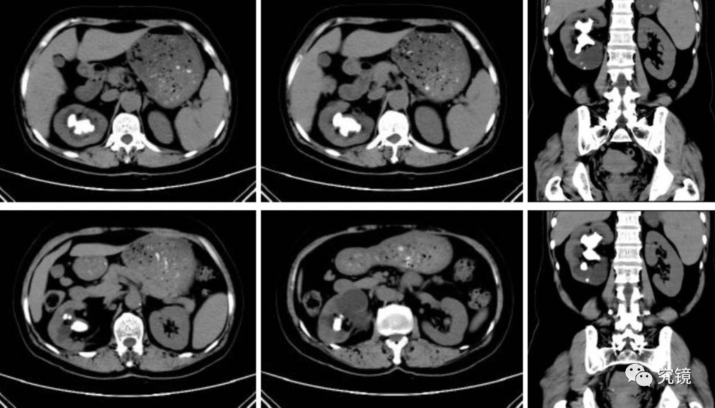 图1.ct提示右肾多发铸型结石